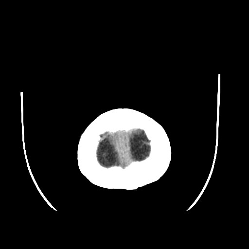 Chronic bilateral subdural hygroma (Radiopaedia 85801-101622 Axial non-contrast 68).jpg
