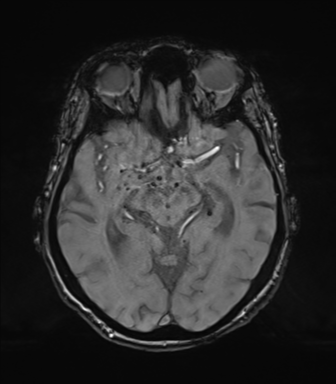 Chronic hypertensive encephalopathy (Radiopaedia 72844-83495 Axial SWI magnitude 35).png