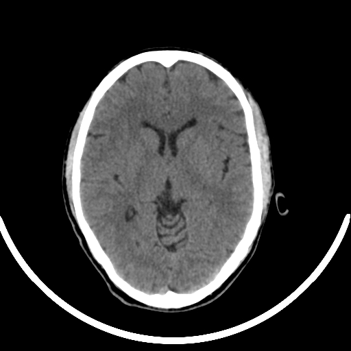 Chronic invasive fungal sinusitis with intraorbital and intracranial extension (Radiopaedia 56387-63046 Axial non-contrast 199).jpg