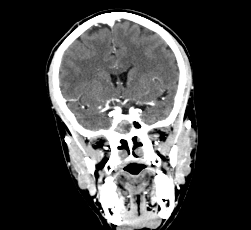 Chronic invasive fungal sinusitis with intraorbital and intracranial extension (Radiopaedia 56387-63046 C 169).jpg