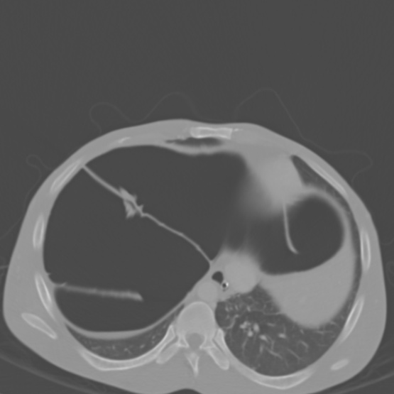 Chronic large bowel pseudo-obstruction (Radiopaedia 43181-46492 Axial bone window 32).jpg