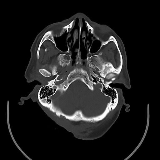Chronic osteomyelitis - calvarial (severe) (Radiopaedia 69668-79616 Axial bone window 29).jpg