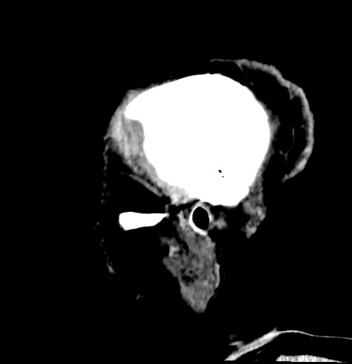 File:Chronic osteomyelitis - calvarial (severe) (Radiopaedia 69668-79616 D 9).jpg