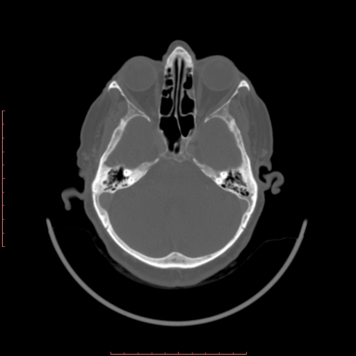 Chronic osteomyelitis - maxilla (Radiopaedia 23783-23927 Axial bone window 129).jpg