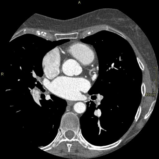 Chronic pulmonary embolism (Radiopaedia 73073-85094 Axial C+ CTPA 81).jpg