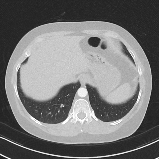 Chronic pulmonary embolus (Radiopaedia 39129-41341 Axial lung window 52).png