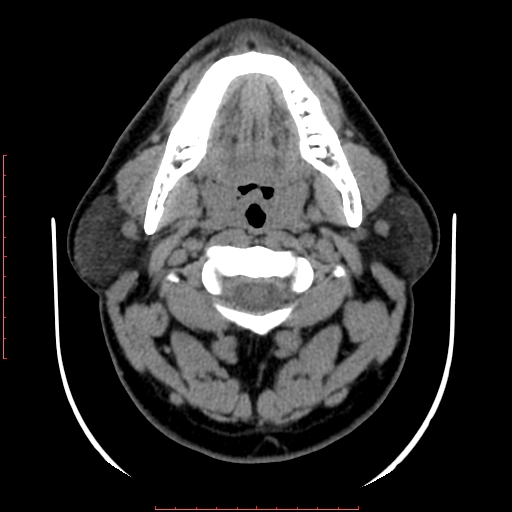 Chronic submandibular sialolithiasis (Radiopaedia 69817-79814 Axial non-contrast 78).jpg