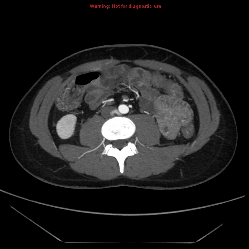 File:Circumaortic left renal vein (Radiopaedia 9069-9792 A 39).jpg