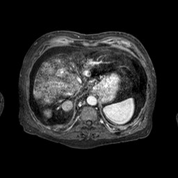 File:Cirrhosis and hepatocellular carcinoma in the setting of hemochromatosis (Radiopaedia 75394-86594 Axial T1 C+ fat sat 230).jpg