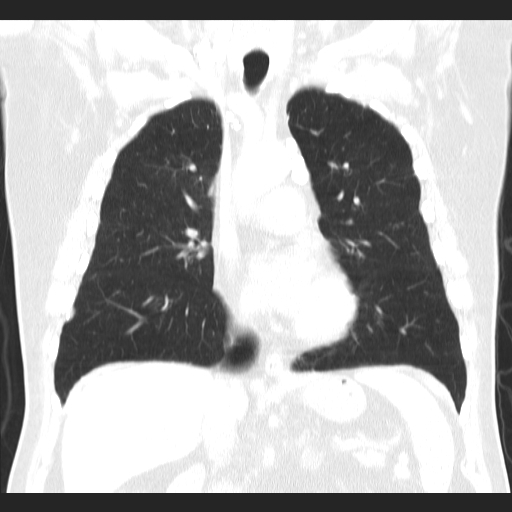 File:Classic complicated silicosis (Radiopaedia 49720-54961 Coronal lung window 27).jpg