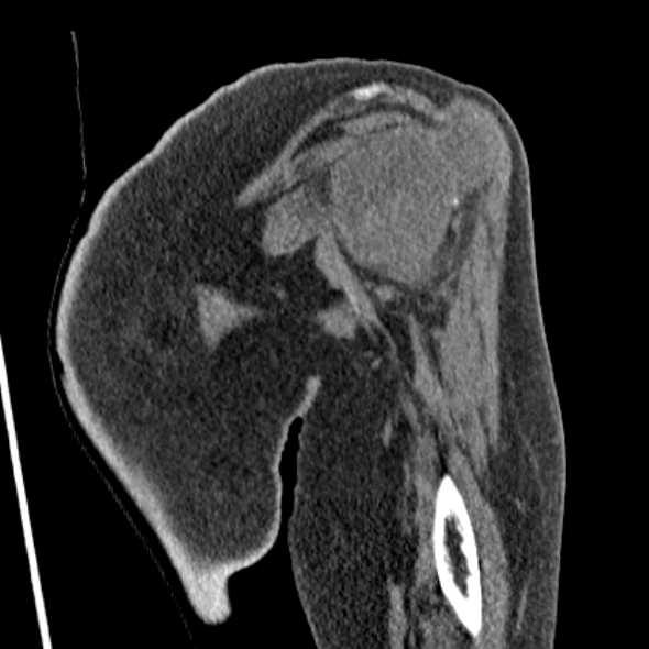 Clear cell chondrosarcoma - humerus (Radiopaedia 63104-71612 Coronal non-contrast 14).jpg