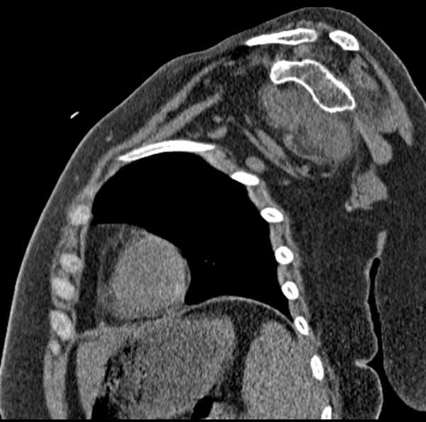 File:Clear cell chondrosarcoma - humerus (Radiopaedia 63104-71612 D 37).jpg