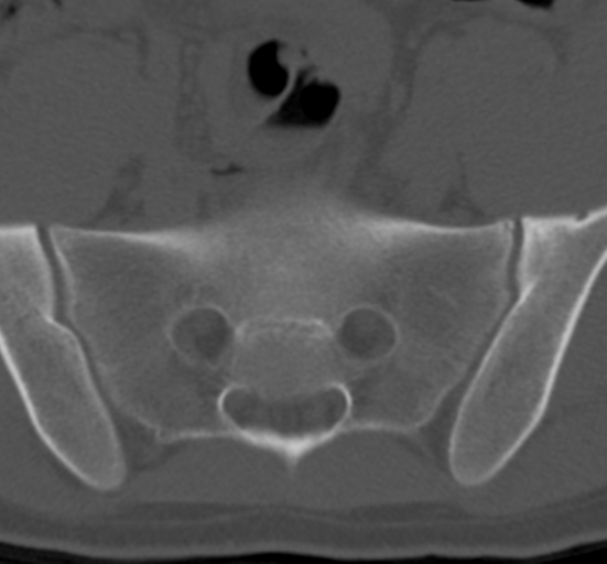 Clear cell meningoma - lumbar spine (Radiopaedia 60116-67691 Axial bone window 74).png