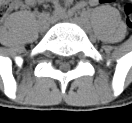 File:Clear cell meningoma - lumbar spine (Radiopaedia 60116-67691 Axial non-contrast 62).png