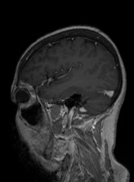 Clival meningioma (Radiopaedia 53278-59248 Sagittal T1 C+ 183).jpg