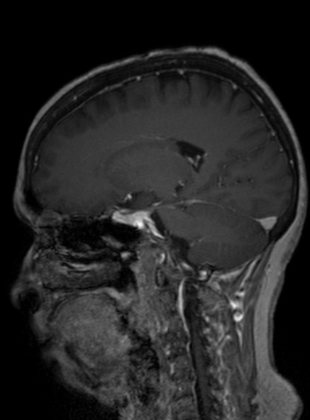 Clival meningioma (Radiopaedia 53278-59248 Sagittal T1 C+ 229).jpg