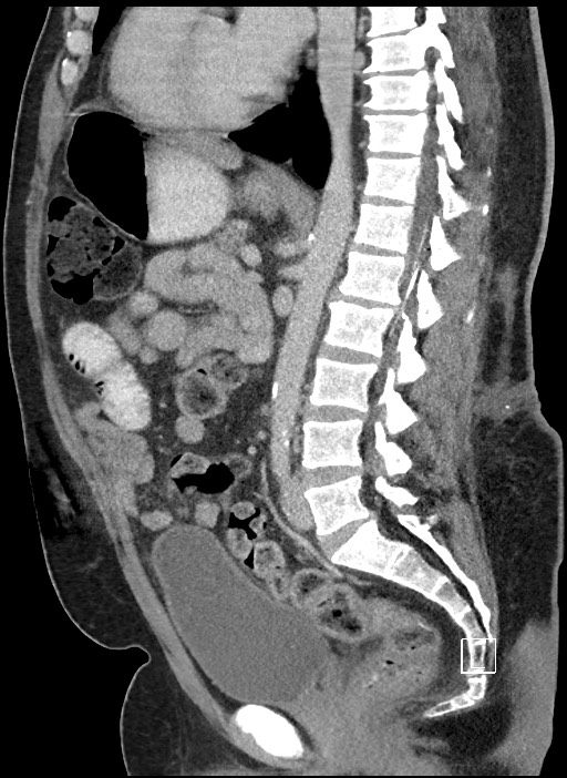 Closed loop obstruction - internal hernia into nephrectomy bed (Radiopaedia 59867-67320 C 42).jpg