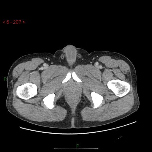 File:Closed loop obstruction and appendicular stump mucocele (Radiopaedia 54014-60163 A 126).jpg