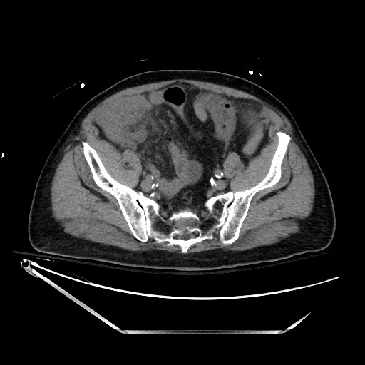 File:Closed loop obstruction due to adhesive band, resulting in small bowel ischemia and resection (Radiopaedia 83835-99023 Axial 34).jpg