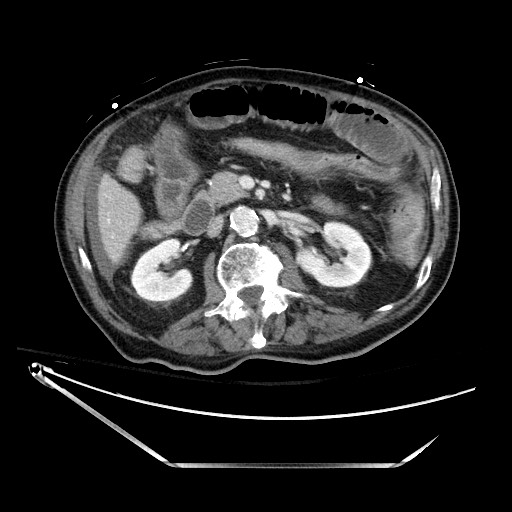 File:Closed loop obstruction due to adhesive band, resulting in small bowel ischemia and resection (Radiopaedia 83835-99023 Axial 435).jpg