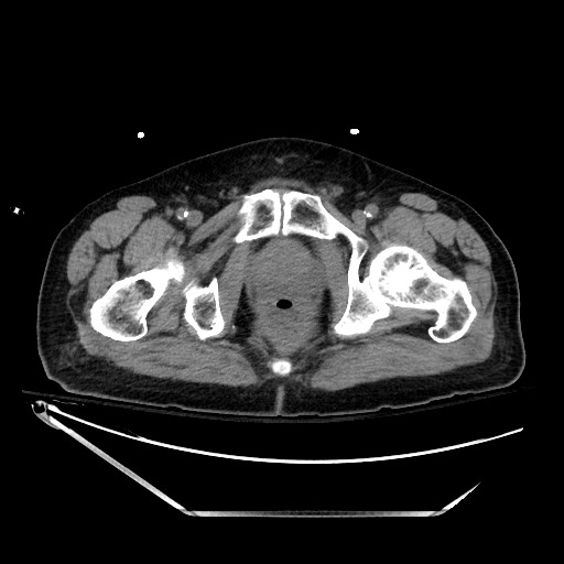 File:Closed loop obstruction due to adhesive band, resulting in small bowel ischemia and resection (Radiopaedia 83835-99023 Axial non-contrast 154).jpg