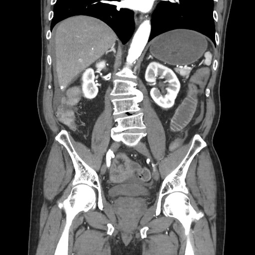 File:Closed loop obstruction due to adhesive band, resulting in small bowel ischemia and resection (Radiopaedia 83835-99023 C 75).jpg