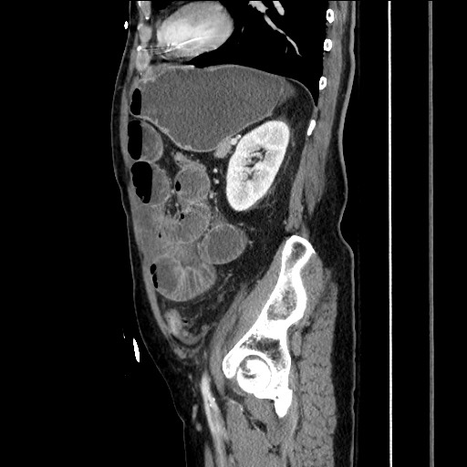 File:Closed loop obstruction due to adhesive band, resulting in small bowel ischemia and resection (Radiopaedia 83835-99023 F 131).jpg
