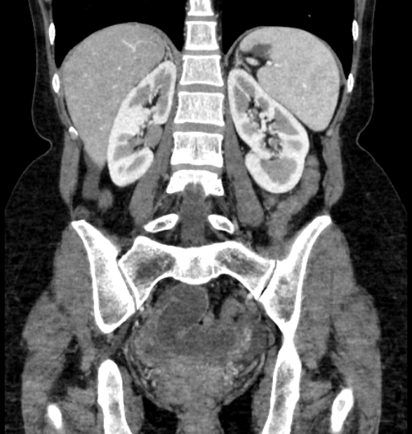 Closed loop small bowel obstruction (Radiopaedia 71211-81508 B 86).jpg