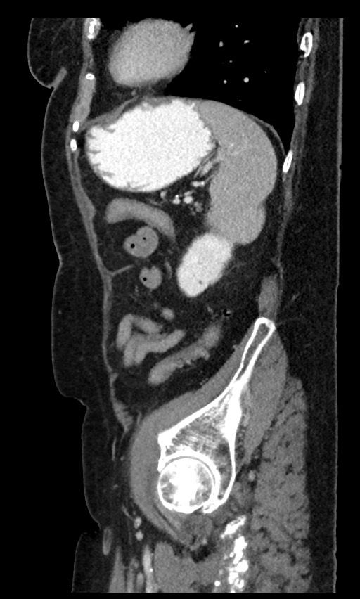 Closed loop small bowel obstruction - adhesions (Radiopaedia 59269-66611 C 28).jpg
