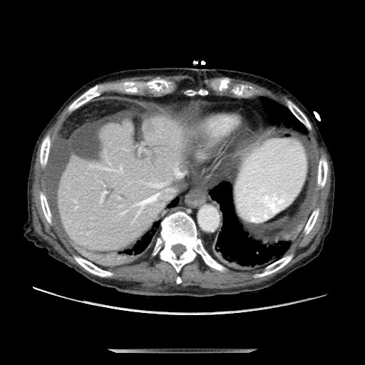 Closed loop small bowel obstruction - adhesive disease and hemorrhagic ischemia (Radiopaedia 86831-102990 A 39).jpg