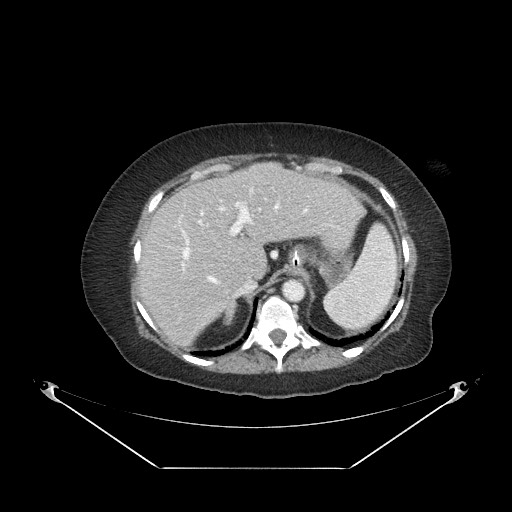 Closed loop small bowel obstruction - internal hernia (Radiopaedia 65402-74450 A 19).jpg