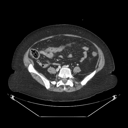 Closed loop small bowel obstruction - internal hernia (Radiopaedia 65402-74450 A 86).jpg