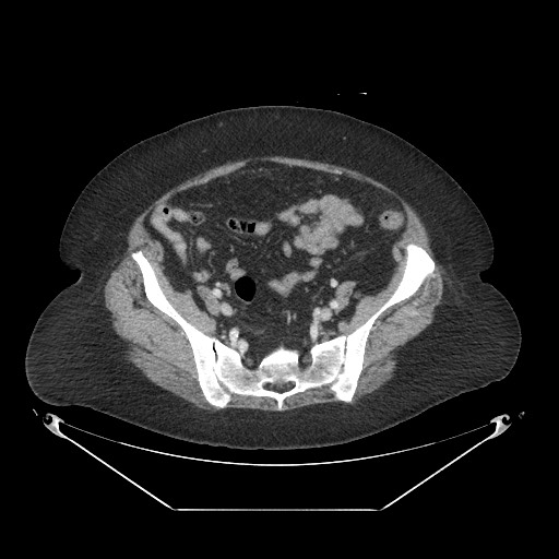 Closed loop small bowel obstruction - internal hernia (Radiopaedia 65402-74450 A 99).jpg