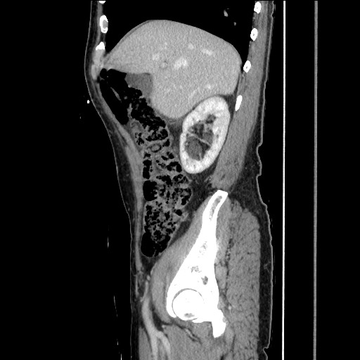 File:Closed loop small bowel obstruction - omental adhesion causing "internal hernia" (Radiopaedia 85129-100682 C 57).jpg