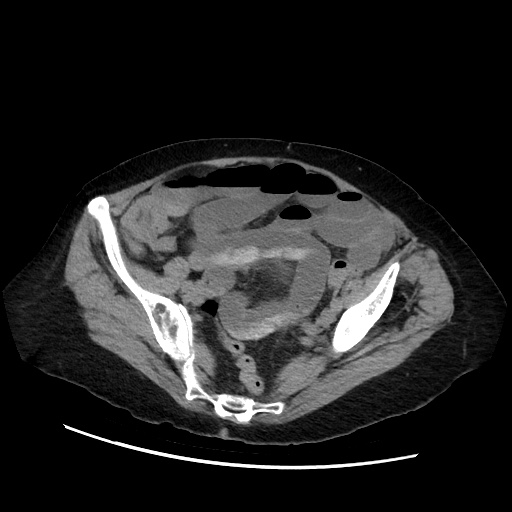 File:Closed loop small bowel obstruction due to adhesive band, with intramural hemorrhage and ischemia (Radiopaedia 83831-99017 Axial non-contrast 125).jpg