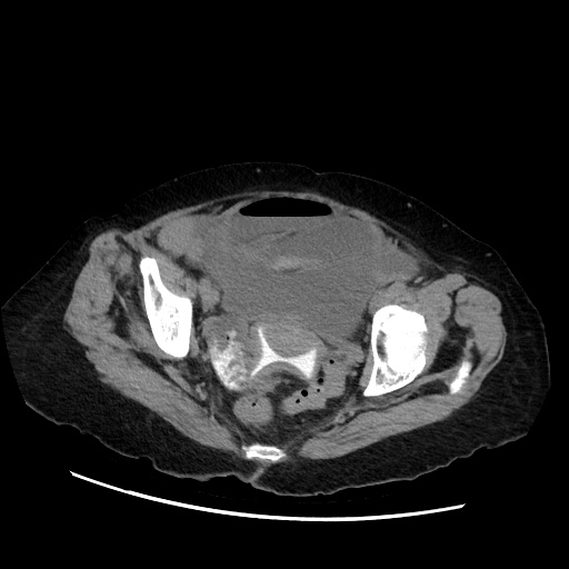 Closed loop small bowel obstruction due to adhesive band, with intramural hemorrhage and ischemia (Radiopaedia 83831-99017 Axial non-contrast 139).jpg