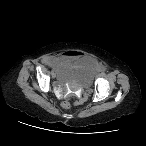 Closed loop small bowel obstruction due to adhesive band, with intramural hemorrhage and ischemia (Radiopaedia 83831-99017 Axial non-contrast 140).jpg