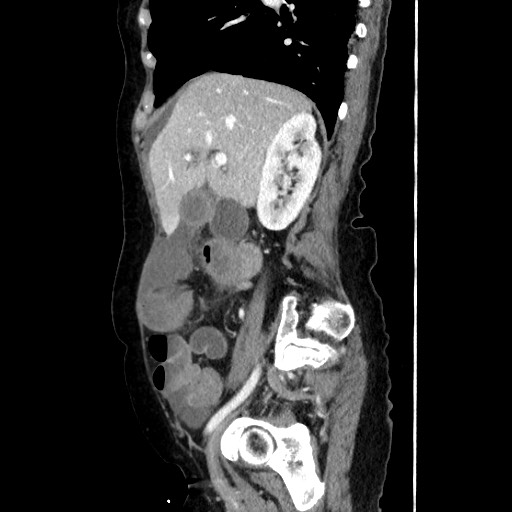 Closed loop small bowel obstruction due to adhesive band, with intramural hemorrhage and ischemia (Radiopaedia 83831-99017 D 76).jpg