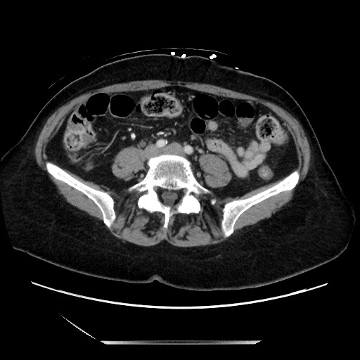 File:Closed loop small bowel obstruction due to adhesive bands - early and late images (Radiopaedia 83830-99014 A 96).jpg