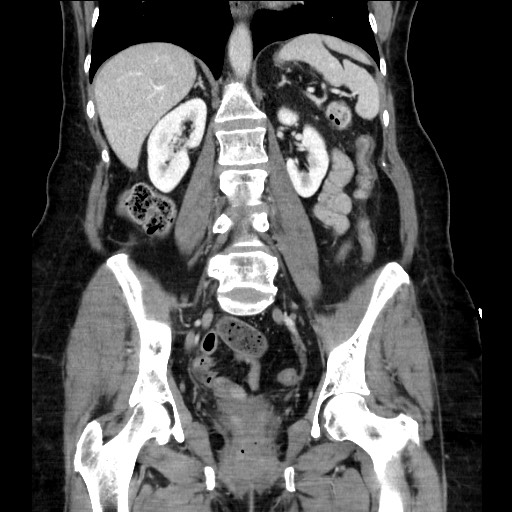 Closed loop small bowel obstruction due to adhesive bands - early and late images (Radiopaedia 83830-99014 B 79).jpg