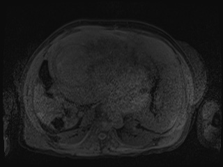 Closed loop small bowel obstruction in pregnancy (MRI) (Radiopaedia 87637-104031 Axial T1 fat sat 72).jpg