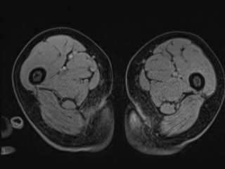Closed loop small bowel obstruction in pregnancy (MRI) (Radiopaedia 87637-104031 G 53).jpg
