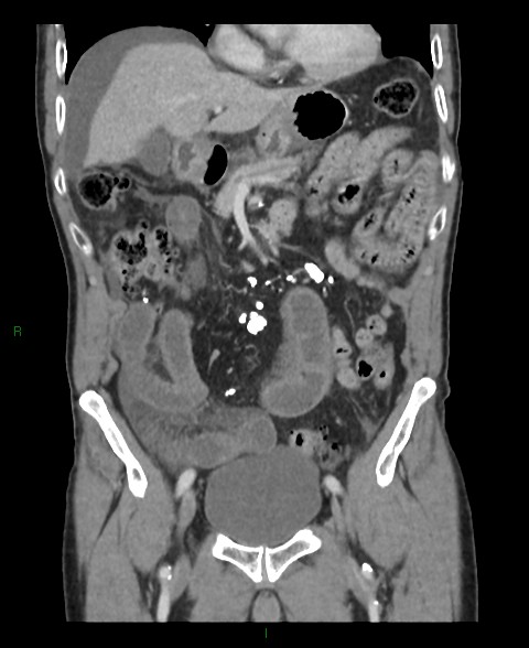 File:Closed loop small bowel obstruction with ischemia (Radiopaedia 84180-99456 B 41).jpg