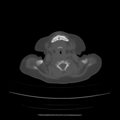 File:Cloverleaf skull (Radiopaedia 91901-109710 Axial bone window 18).jpg