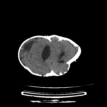 Cloverleaf skull (Radiopaedia 91901-109710 Axial non-contrast 118).jpg
