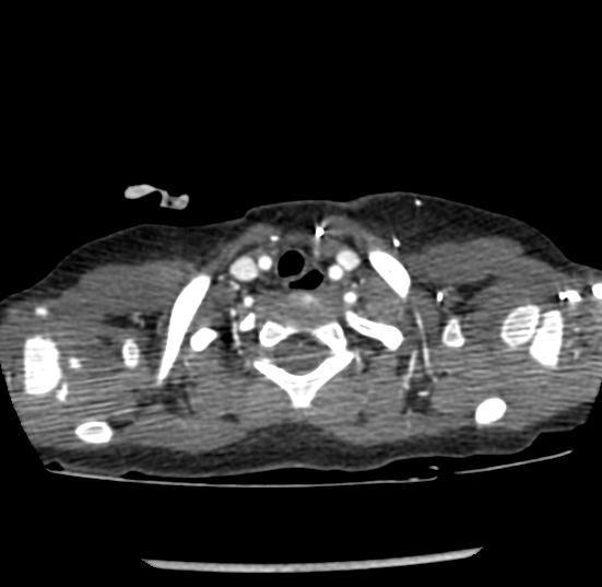 Coarctation of aorta (Radiopaedia 27427-27622 Axial C+ CTPA 4).png