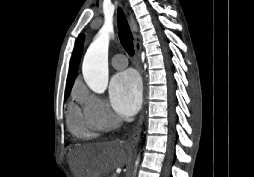 Coarctation of aorta with aortic valve stenosis (Radiopaedia 70463-80574 B 50).jpg