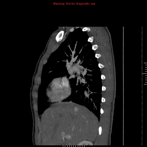 File:Coarctation of the aorta (Radiopaedia 9434-10118 B 14).jpg
