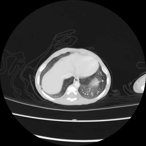 Coarctation of the aorta and patent ductus arteriosus (Radiopaedia 68033-77499 Axial lung window 52).jpg