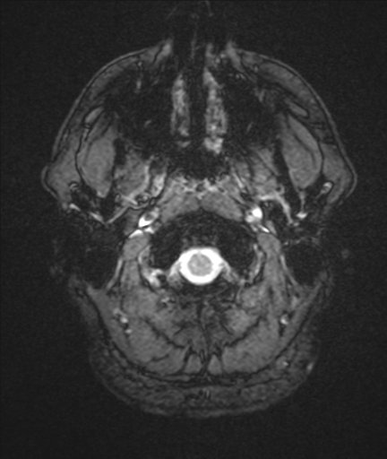 File:Colloid cyst (Radiopaedia 44510-48181 Axial Gradient Echo 2).png